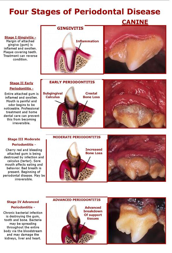 Four Stages of Periodontal Disease